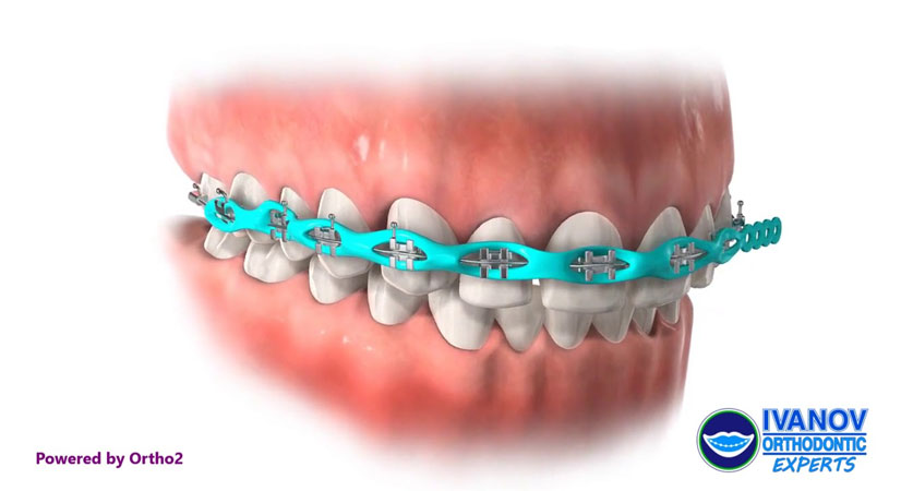 braces colors