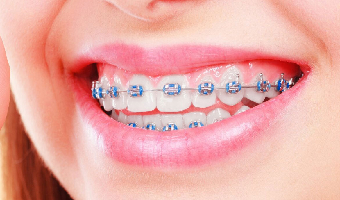 overbite braces