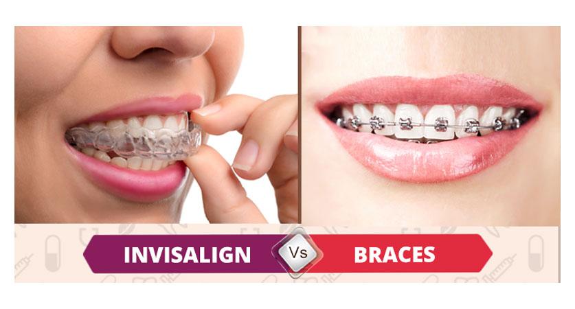 braces with missing teeth