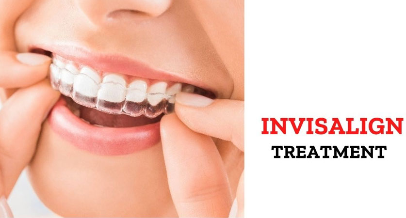 Why Do You Need Invisalign Treatment