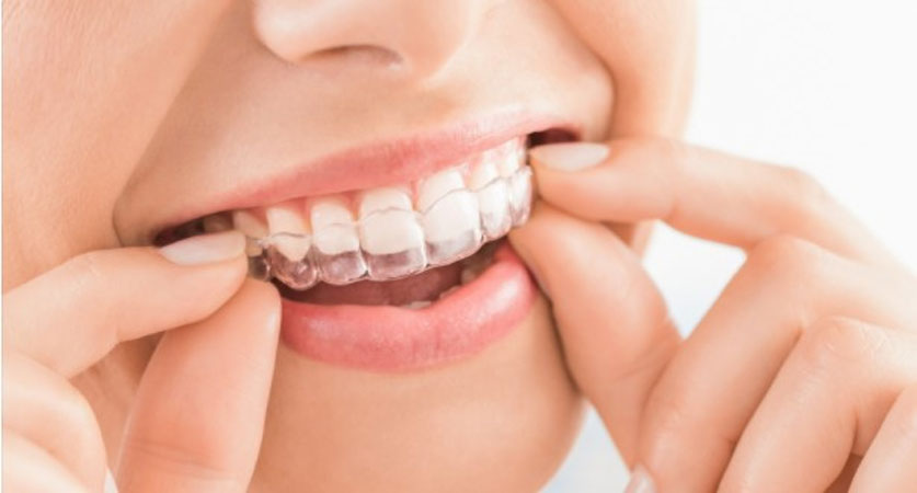 Invisalign Teeth Braces