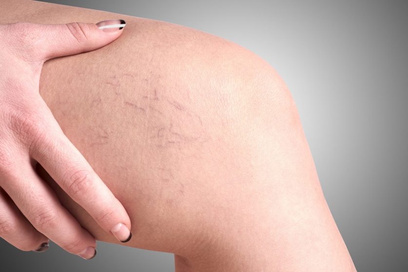 Veins Treatment Options