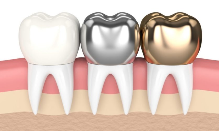 Tooth Crowns
