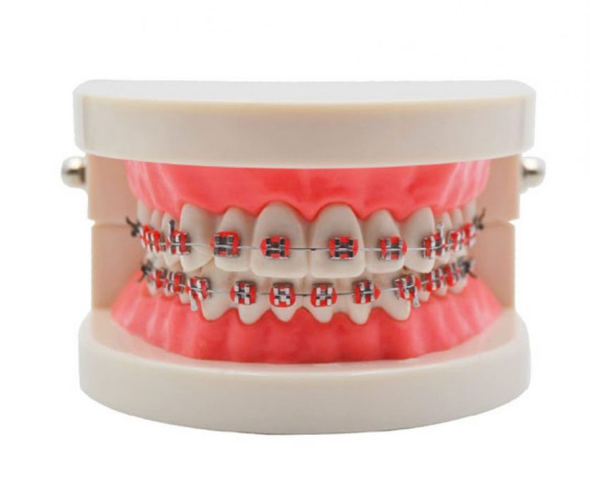 best braces colors