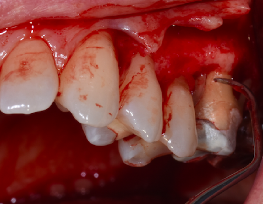 Periodontitis Treatment