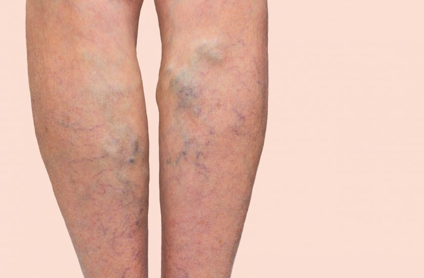 Varicose Veins