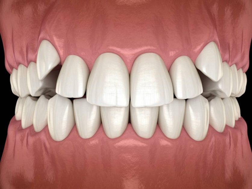 overbite braces