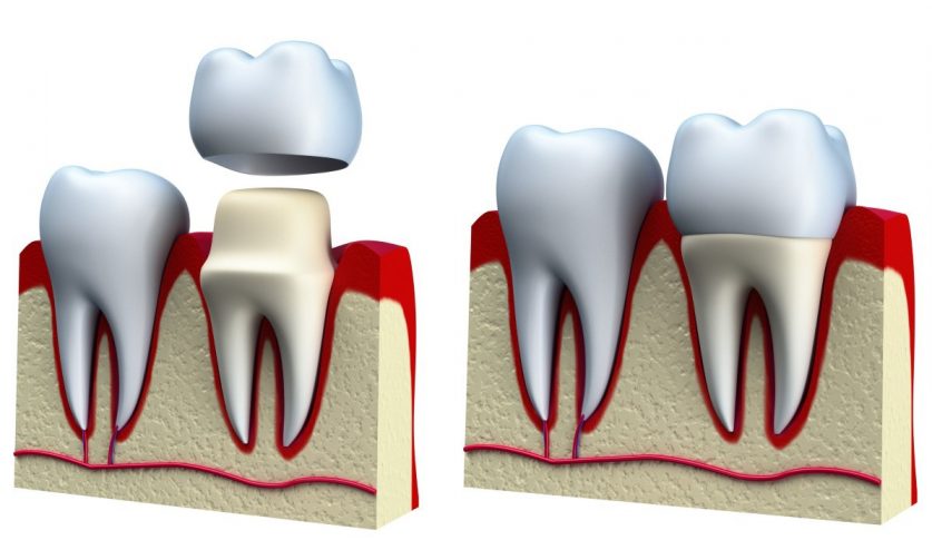 Dental Crowns