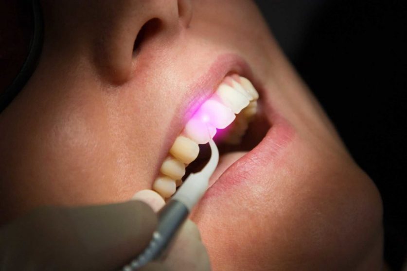 LANAP Laser Gum Surgery