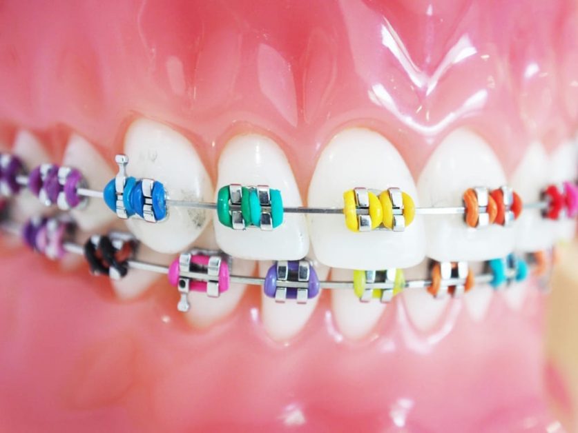 Braces Color