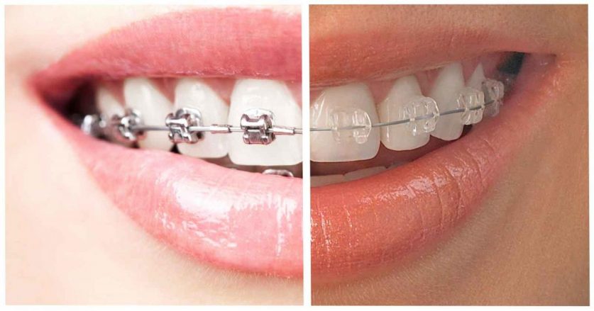 metal braces