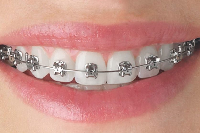 braces near me