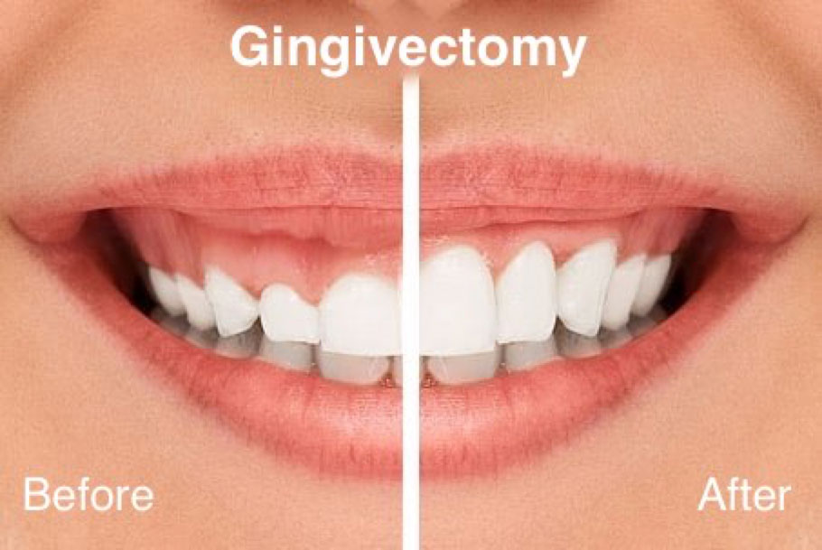 Gingivectomy