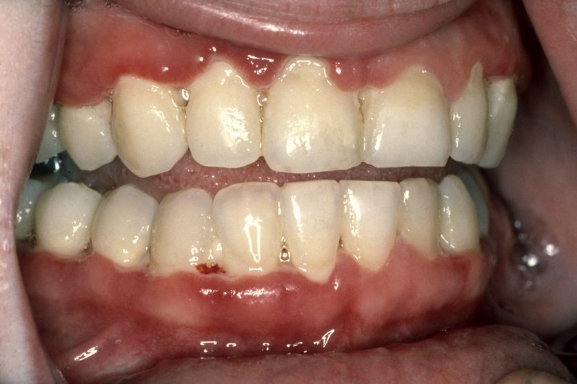 Gingivitis Treatment