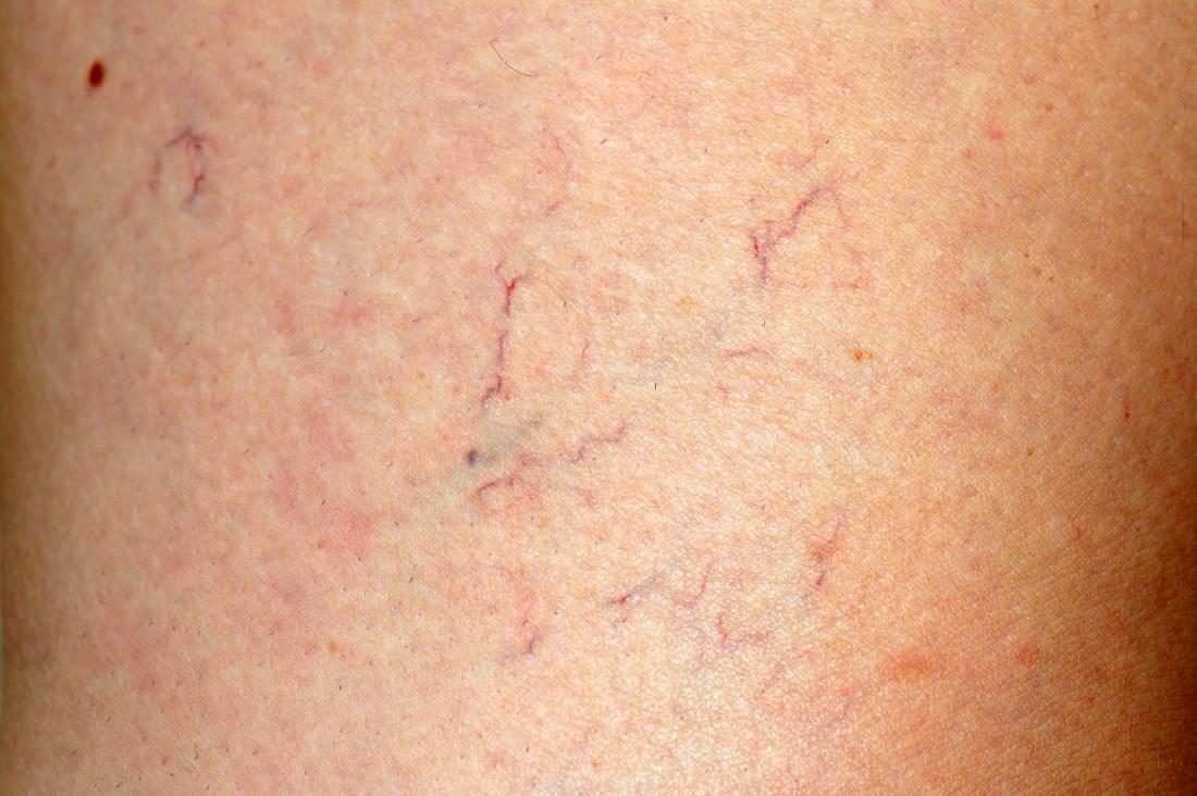 spider veins