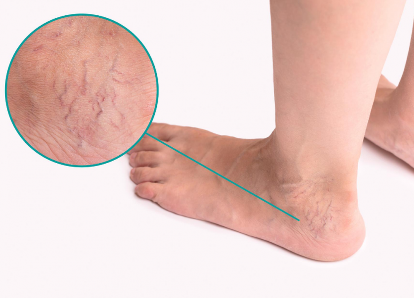 Varicose Veins