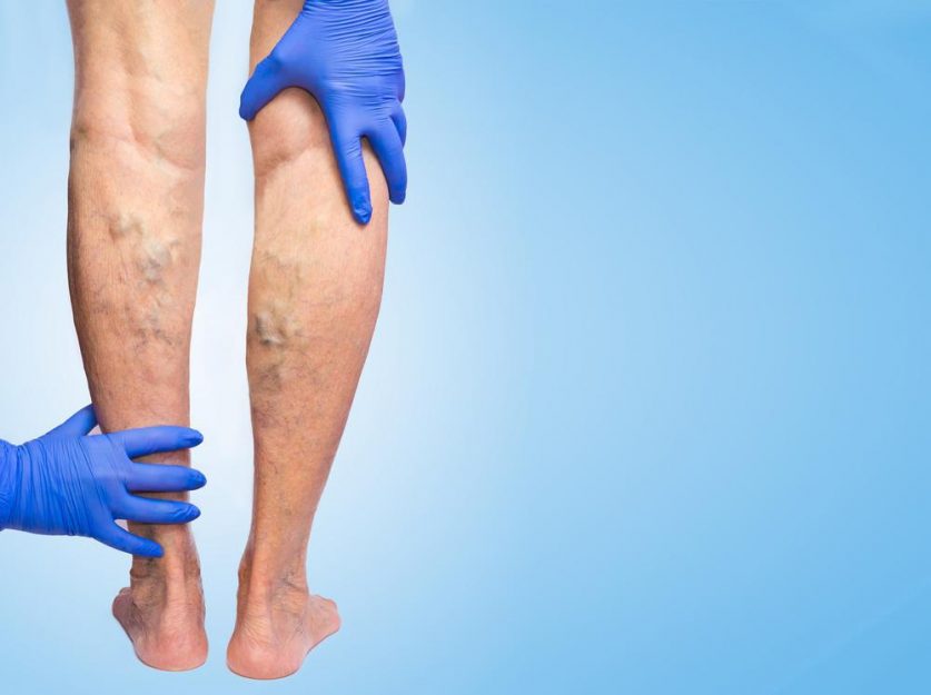 Varicose Vein Removal