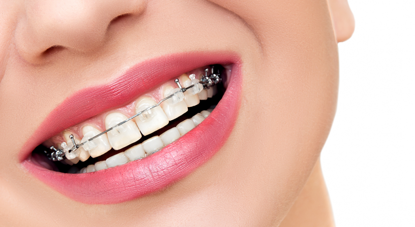 braces with missing teeth