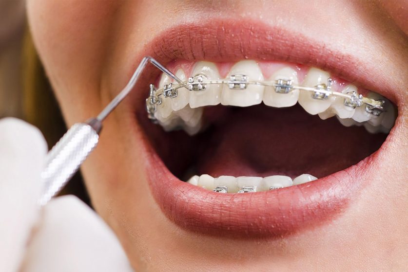 Orthodontic Treatment