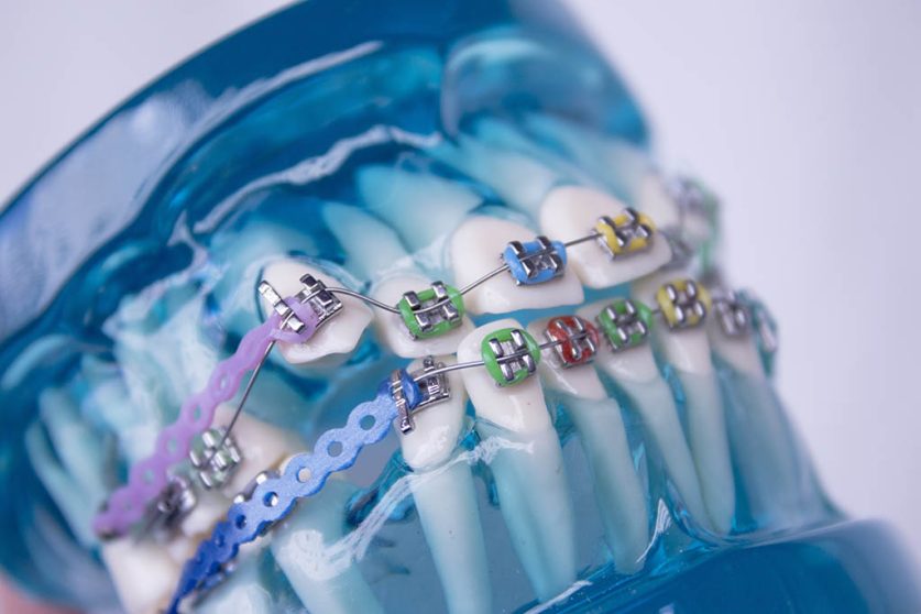 best braces colors