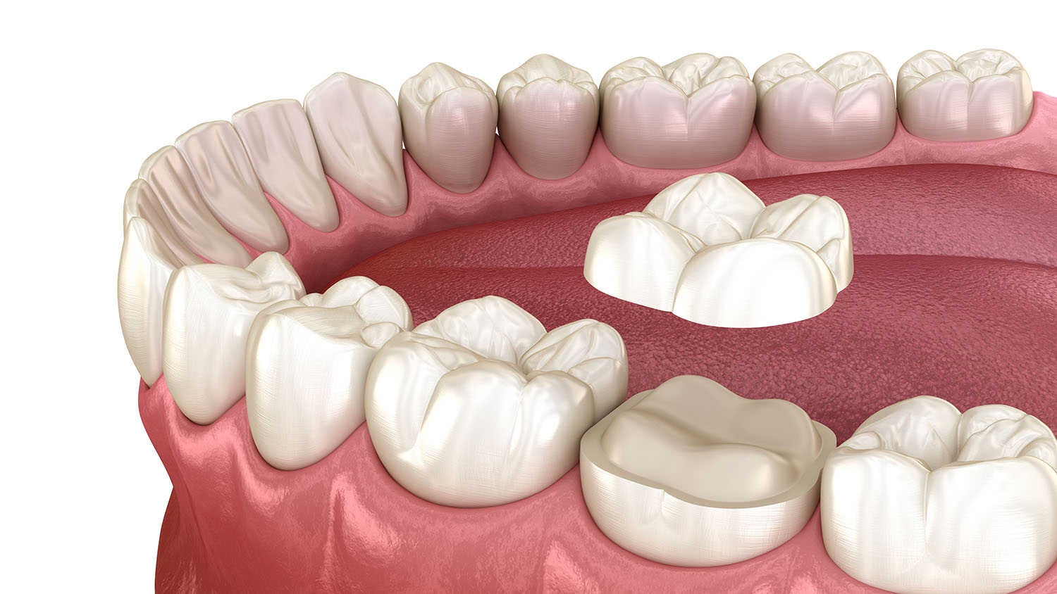 root canal treatment