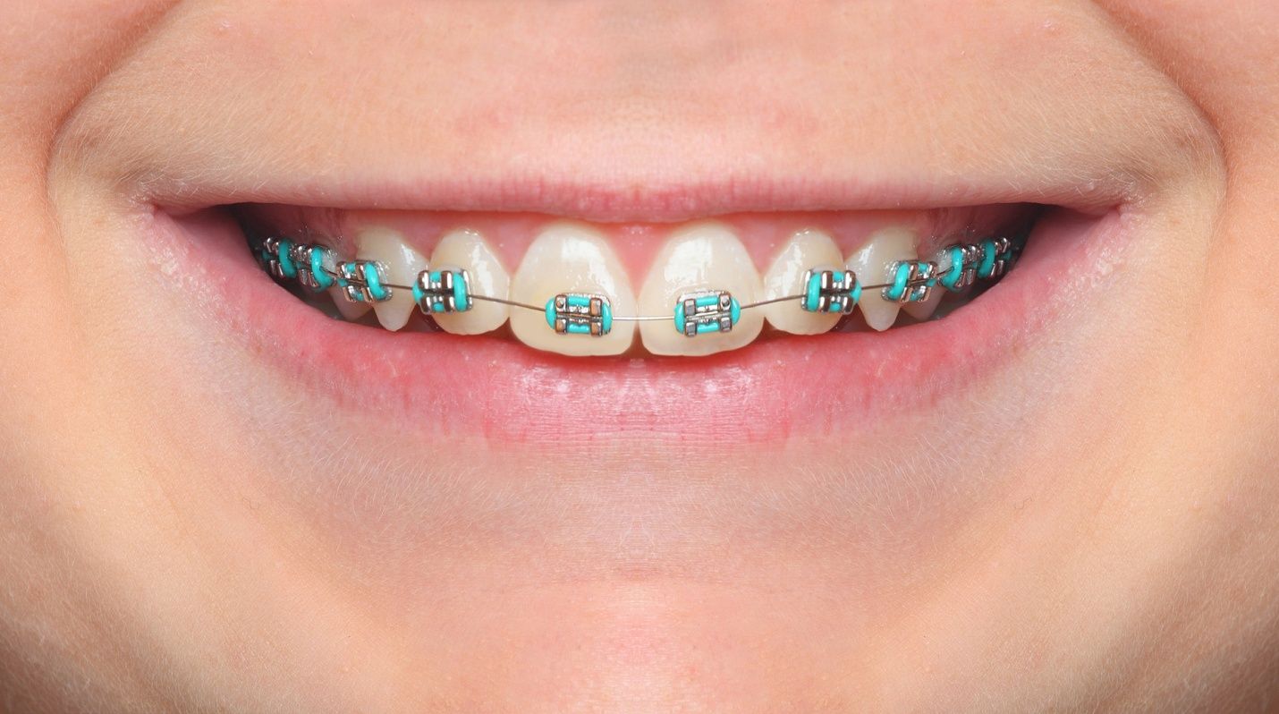 braces color wheel