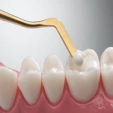 composite fillings Near Me