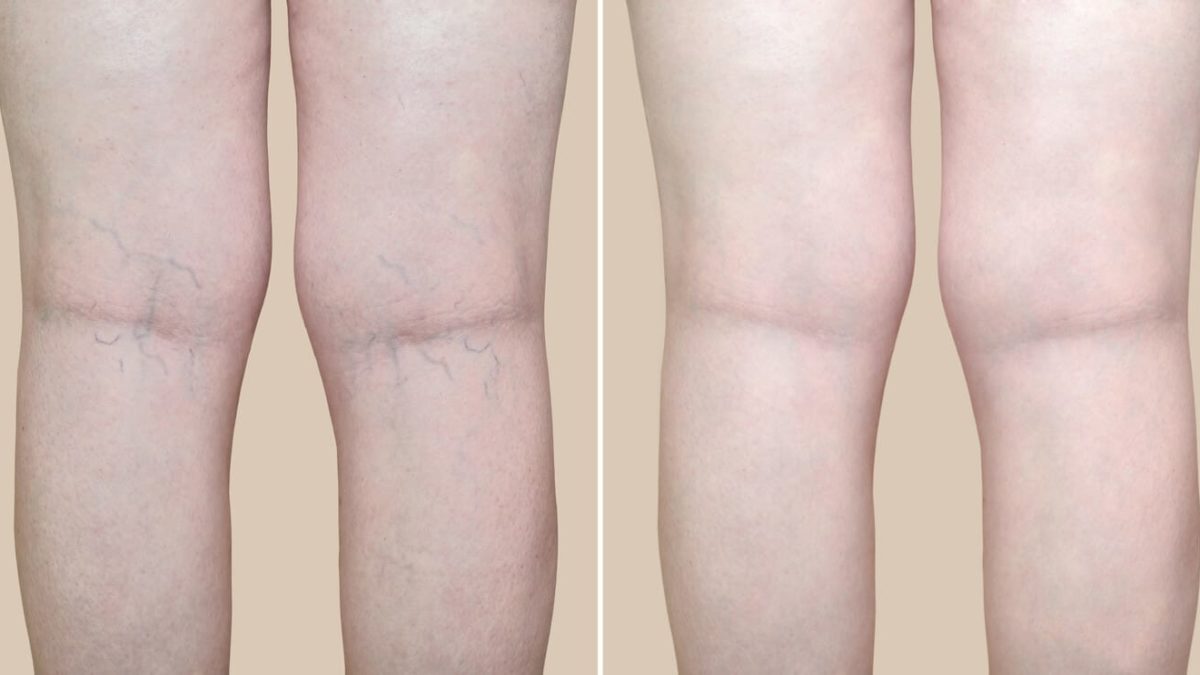 the treatment options for varicose veins