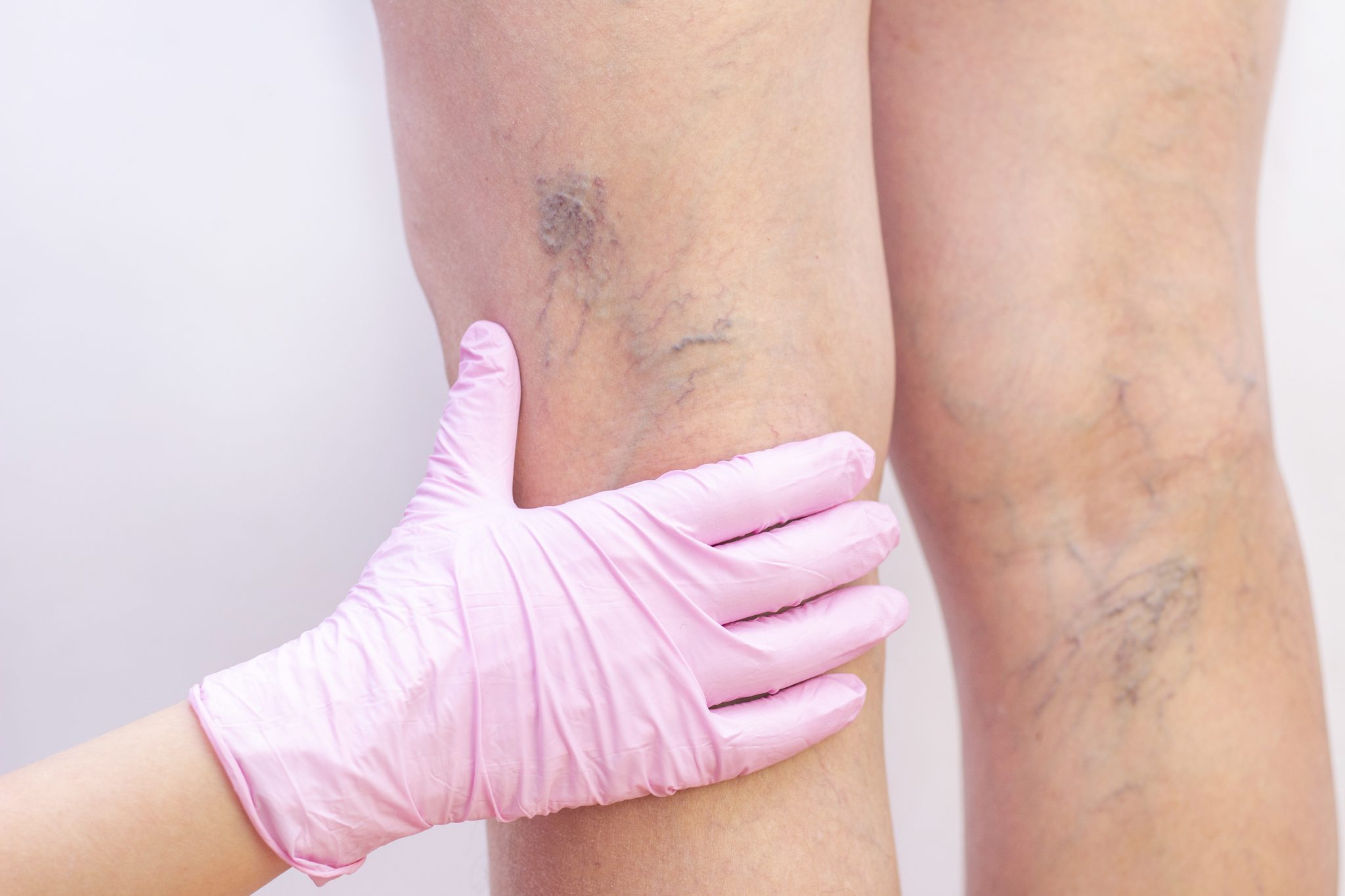 What Kind of Specialist Treats Varicose Veins