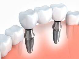 Houston Dental Implants