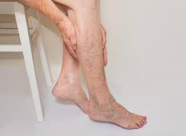 What is the treatment for varicose veins