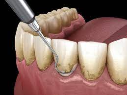 periodontal disease treatment