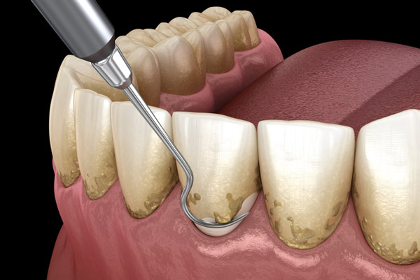 deep cleaning teeth in Houston, TX