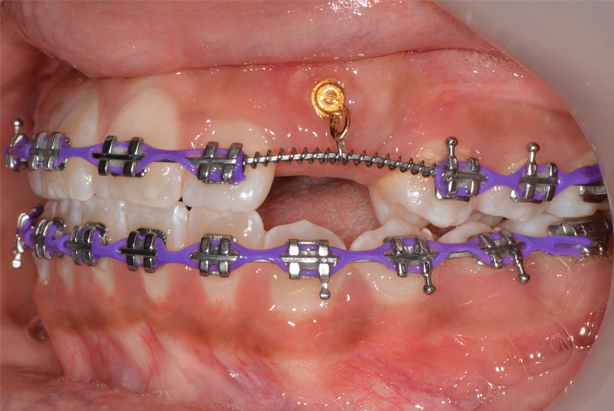 dark purple braces