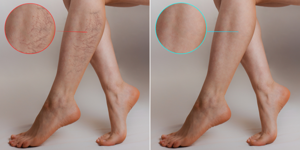 How Much Does Varicose Vein Treatment Cost