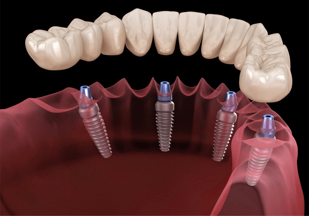 All on 4 Dental Implant
