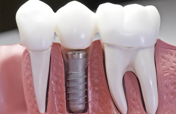 Multiple Teeth Implants