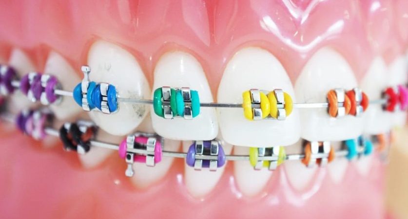 How to choose the ideal shade of braces How to choose the ideal shade of braces