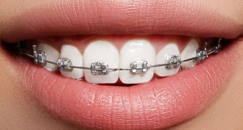 Why Are Certain Colors the Best Choice for Braces?